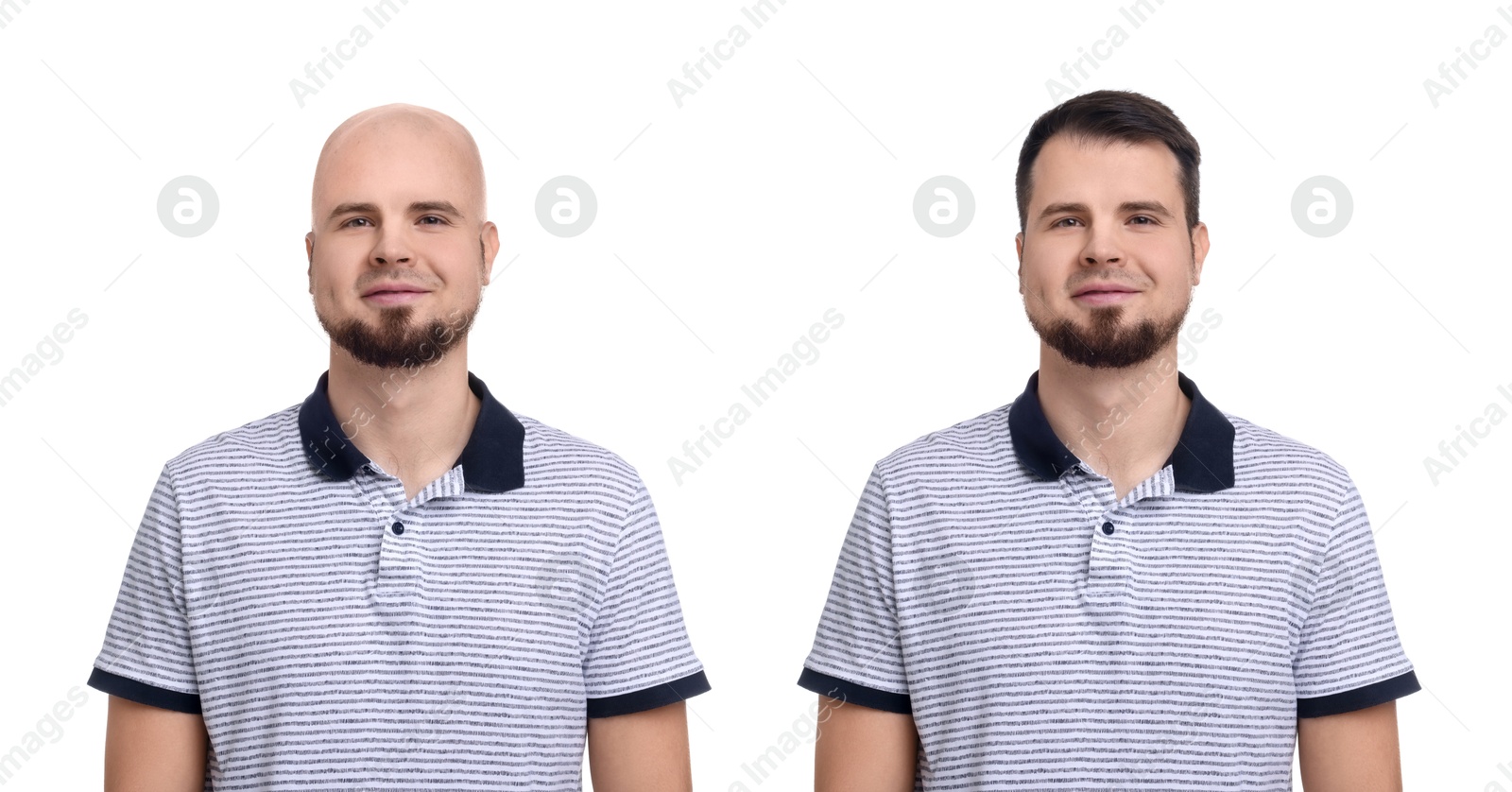Baldness. Man before and after wearing wig or hair treatment, collage Image of Baldness. Man before and after wearing wig or hair treatment, collage