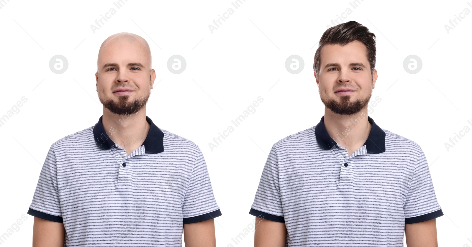 Baldness. Man before and after wearing wig or hair treatment, collage Image of Baldness. Man before and after wearing wig or hair treatment, collage