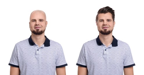 Image of Baldness. Man before and after wearing wig or hair treatment, collage