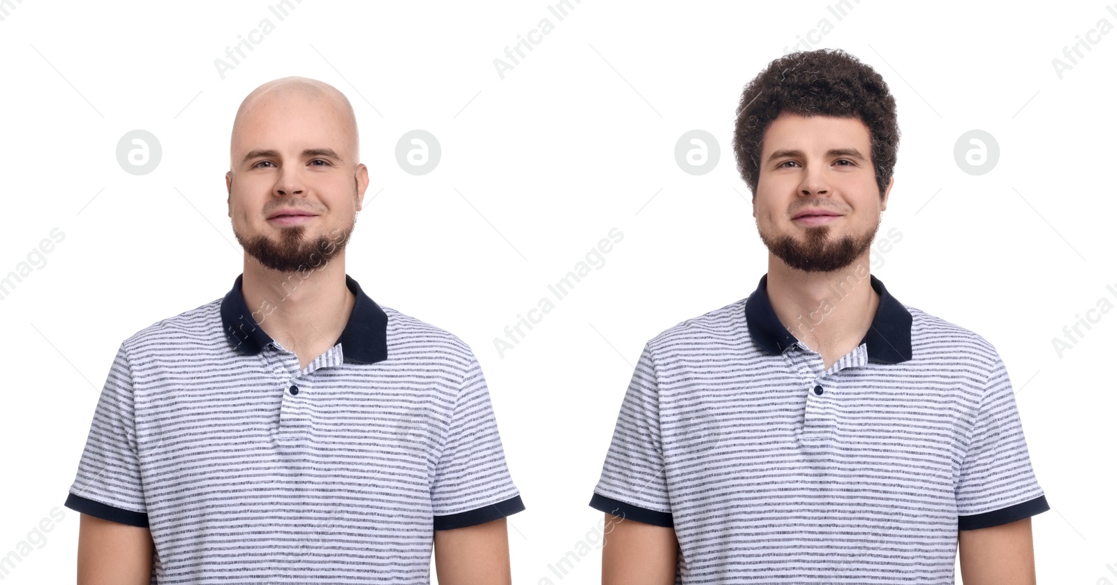 Baldness. Man before and after wearing wig or hair treatment, collage Image of Baldness. Man before and after wearing wig or hair treatment, collage