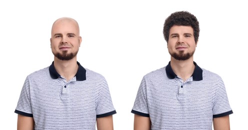 Image of Baldness. Man before and after wearing wig or hair treatment, collage