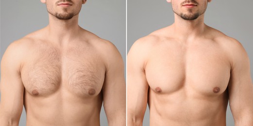 Image of Epilation. Collage with photos of man showing chest before and after procedure on grey background, closeup