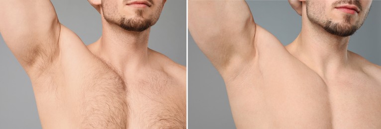 Image of Before and after epilation. Collage with photos of man showing armpit and chest on grey background, closeup