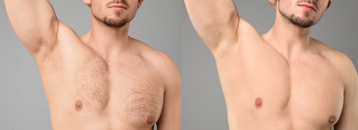 Image of Before and after epilation. Collage with photos of man showing armpit and chest on grey background, closeup