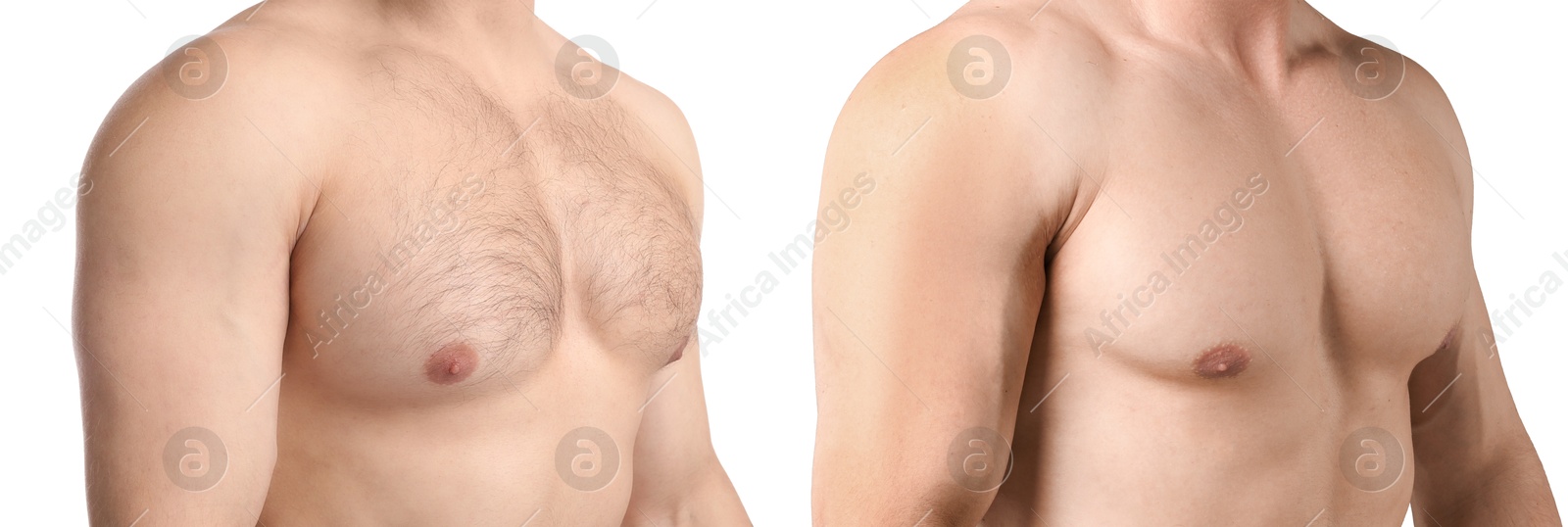 Man showing chest before and after epilation procedure on white background, closeup. Collage of photos Image of Man showing chest before and after epilation procedure on white background, closeup. Collage of photos