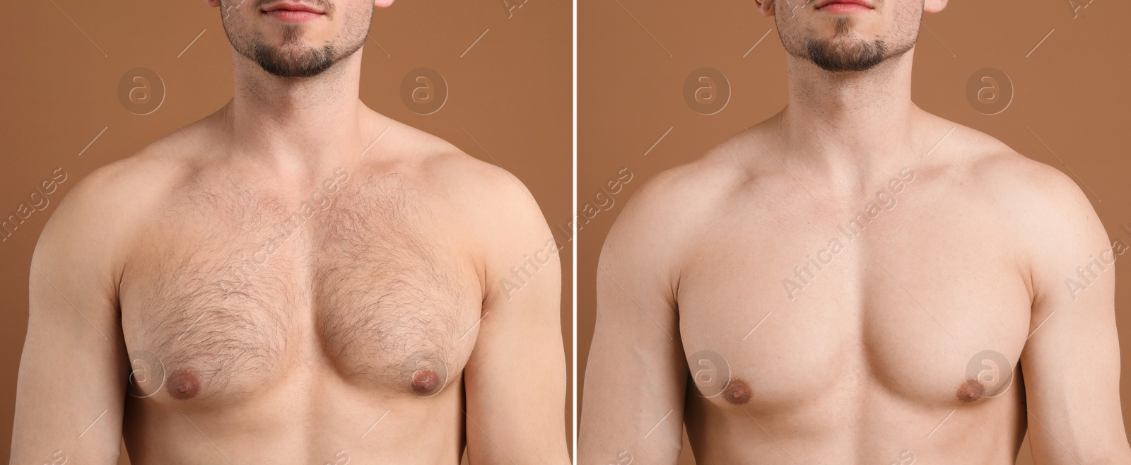 Man showing chest before and after epilation procedure on brown background, closeup. Collage of photos Image of Man showing chest before and after epilation procedure on brown background, closeup. Collage of photos