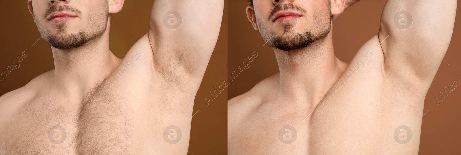 Man showing armpit and chest before and after epilation procedure on brown background, closeup. Collage of photos Image of Man showing armpit and chest before and after epilation procedure on brown background, closeup. Collage of photos