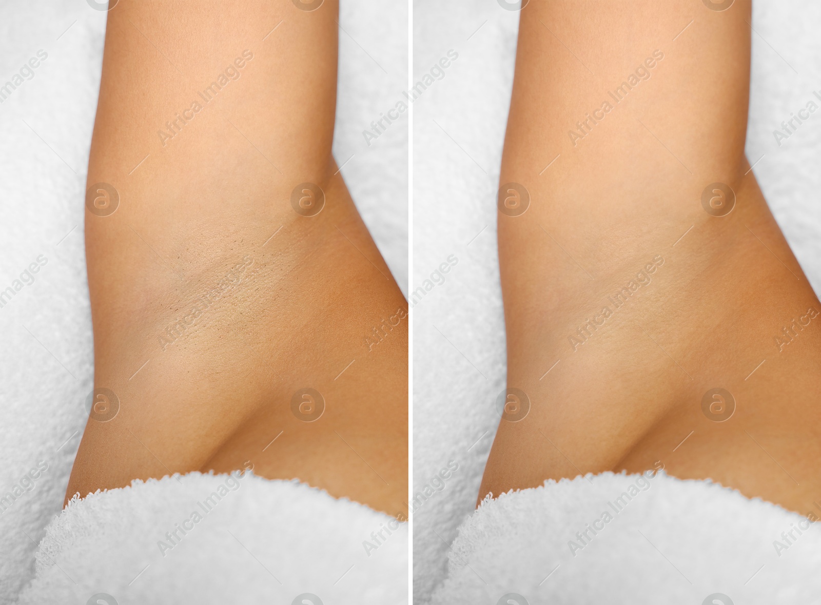 Epilation and depilation. Collage with photos of woman showing armpit after different procedures on light background, closeup Image of Epilation and depilation. Collage with photos of woman showing armpit after different procedures on light background, closeup