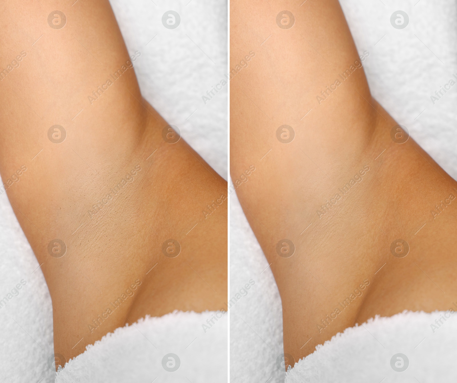 Epilation and depilation. Collage with photos of woman showing armpit after different procedures on light background, closeup Image of Epilation and depilation. Collage with photos of woman showing armpit after different procedures on light background, closeup