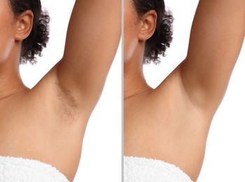 Image of Before and after epilation. Woman showing armpit on white background, closeup. Collage