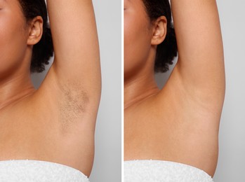 Image of Epilation, hair removal. Woman showing armpit before and after procedure on grey background, closeup. Collage