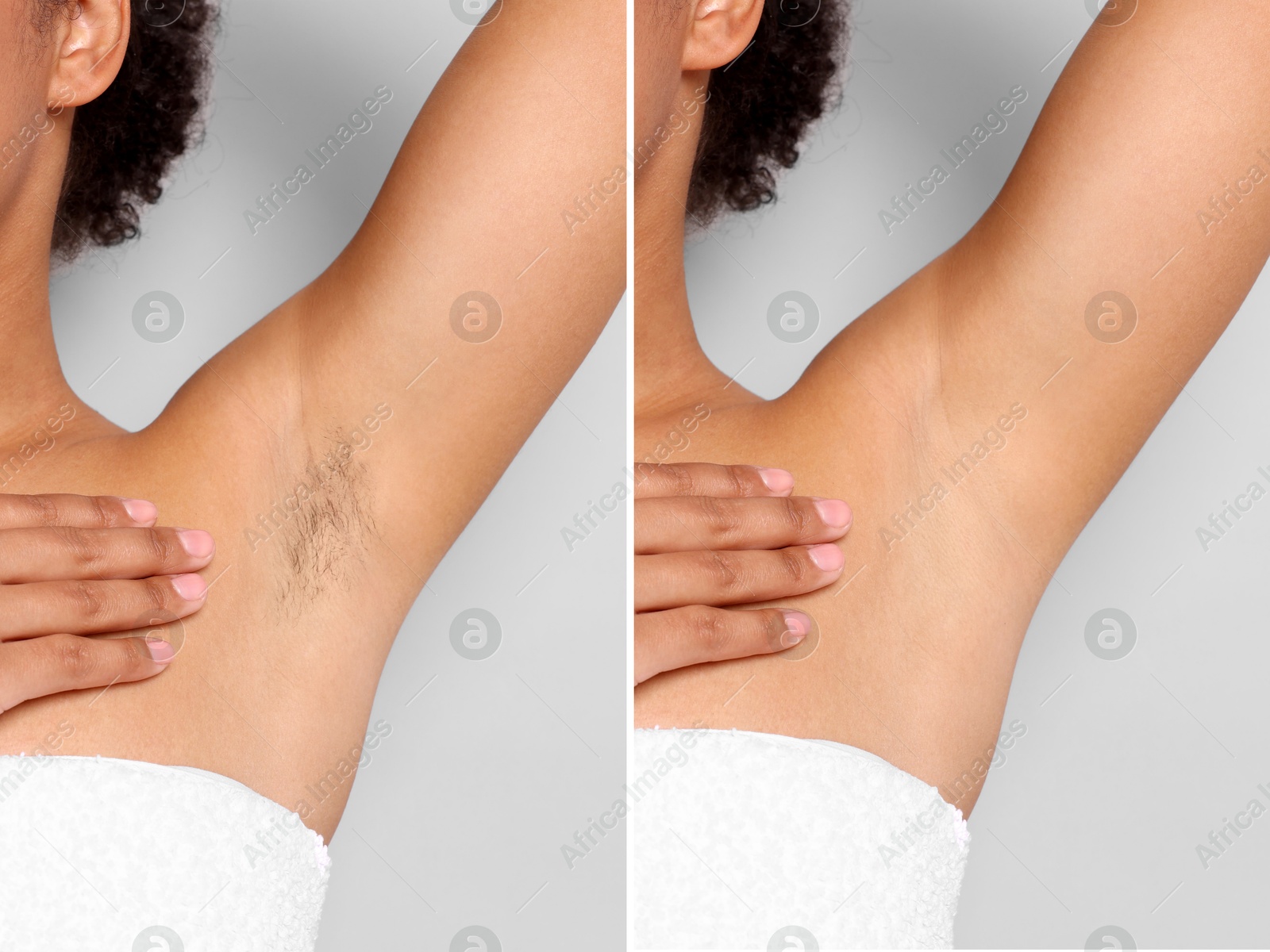 Epilation, hair removal. Woman showing armpit before and after procedure on grey background, closeup. Collage Image of Epilation, hair removal. Woman showing armpit before and after procedure on grey background, closeup. Collage