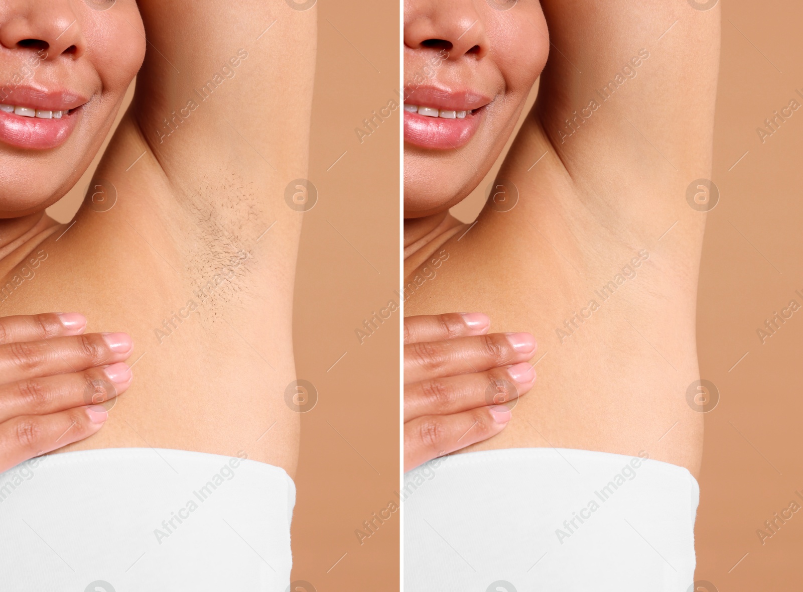 Epilation, hair removal. Woman showing armpit before and after procedure on dark beige background, closeup. Collage Image of Epilation, hair removal. Woman showing armpit before and after procedure on dark beige background, closeup. Collage
