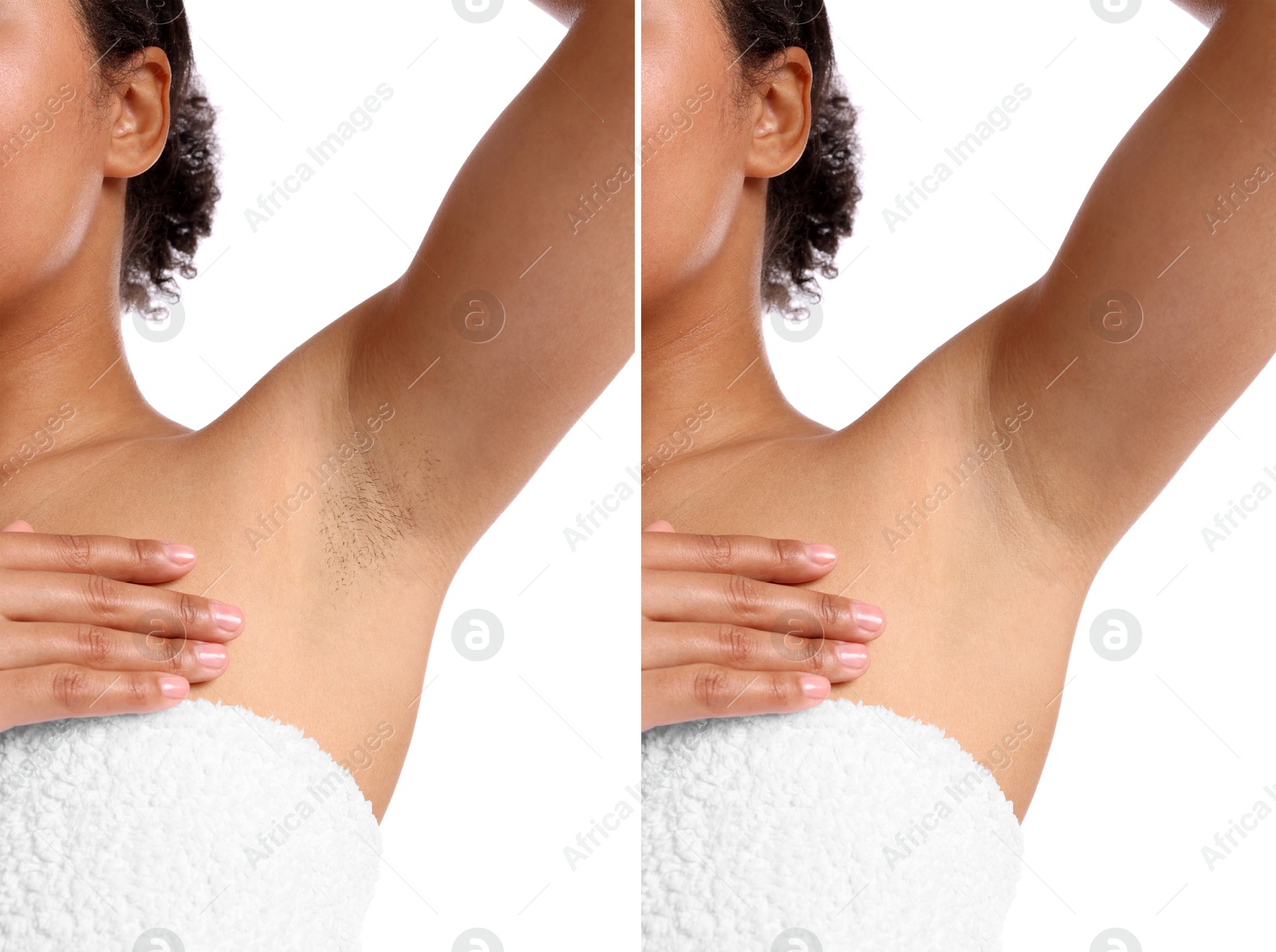 Before and after epilation. Woman showing armpit on white background, closeup. Collage Image of Before and after epilation. Woman showing armpit on white background, closeup. Collage