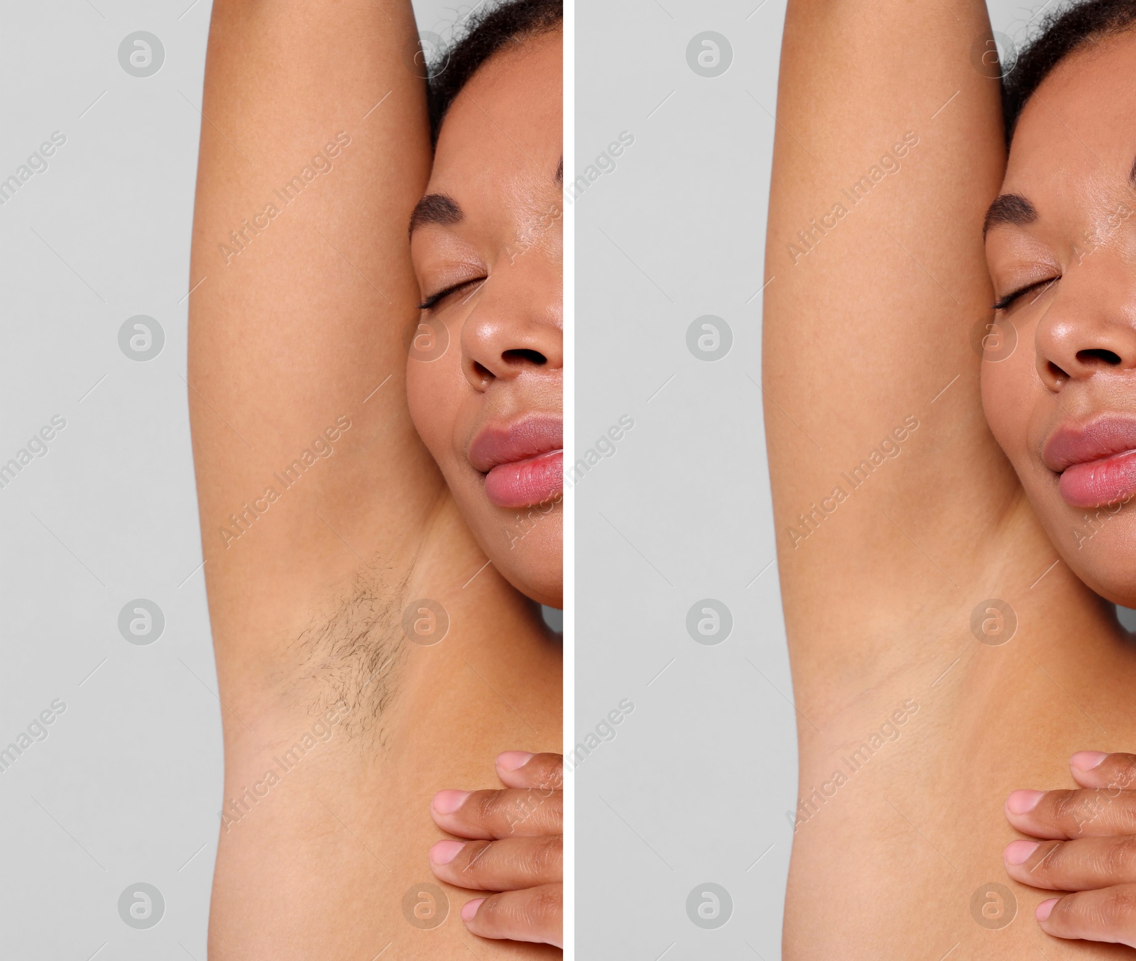 Epilation, hair removal. Woman showing armpit before and after procedure on grey background, closeup. Collage Image of Epilation, hair removal. Woman showing armpit before and after procedure on grey background, closeup. Collage