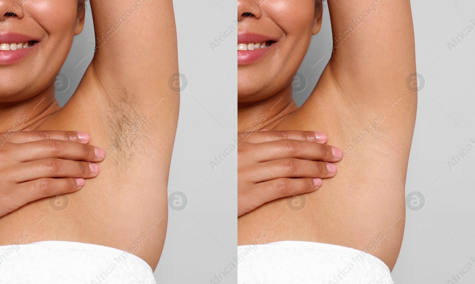 Before and after epilation. Collage with photos of woman showing armpit on grey background, closeup Image of Before and after epilation. Collage with photos of woman showing armpit on grey background, closeup