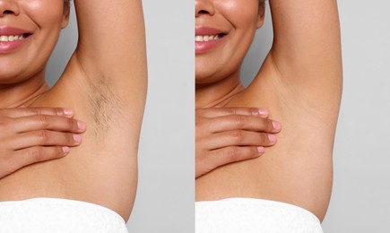 Image of Before and after epilation. Collage with photos of woman showing armpit on grey background, closeup