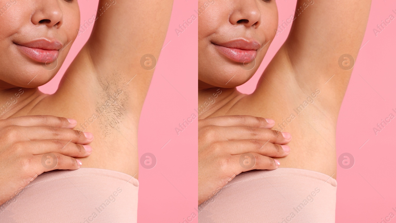Image of Before and after epilation. Woman showing armpit on pink background, closeup. Collage