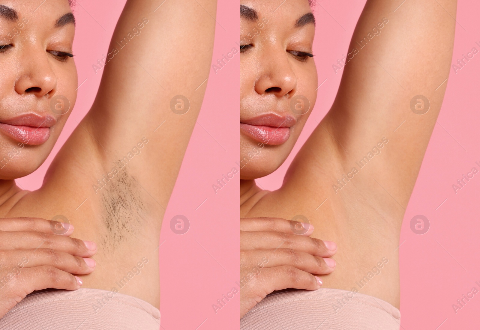 Before and after epilation. Woman showing armpit on pink background, closeup. Collage Image of Before and after epilation. Woman showing armpit on pink background, closeup. Collage
