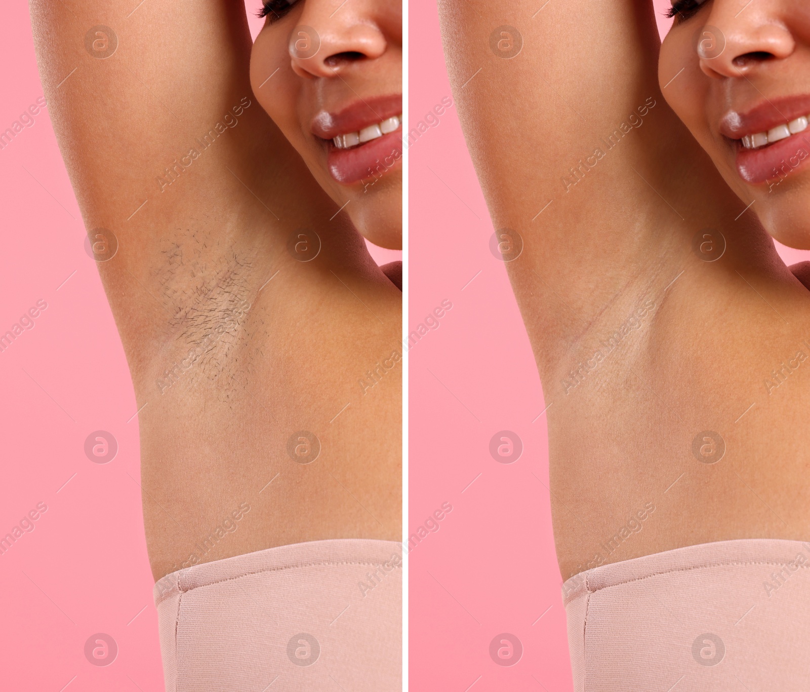 Image of Before and after epilation. Woman showing armpit on pink background, closeup. Collage