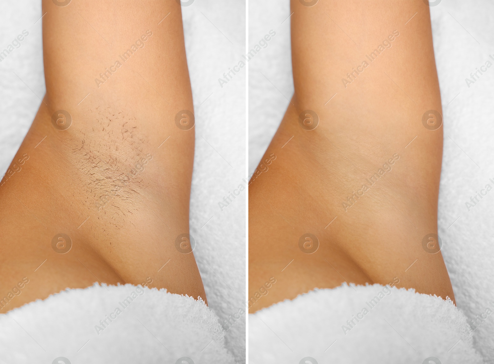 Epilation, hair removal. Woman showing armpit before and after procedure on light background, closeup. Collage Image of Epilation, hair removal. Woman showing armpit before and after procedure on light background, closeup. Collage