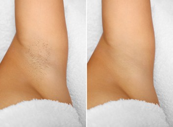 Image of Epilation, hair removal. Woman showing armpit before and after procedure on light background, closeup. Collage