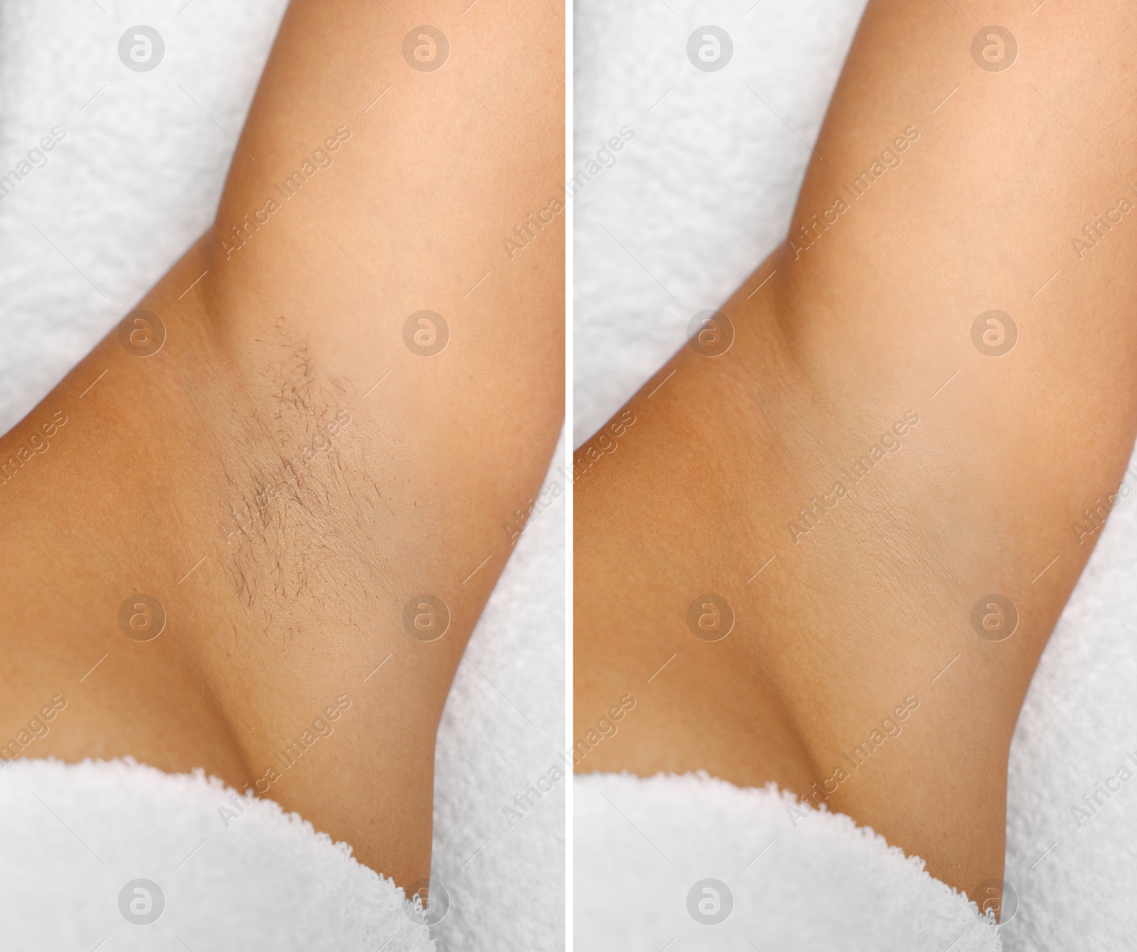 Epilation, hair removal. Woman showing armpit before and after procedure on light background, closeup. Collage Image of Epilation, hair removal. Woman showing armpit before and after procedure on light background, closeup. Collage
