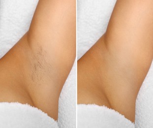 Image of Epilation, hair removal. Woman showing armpit before and after procedure on light background, closeup. Collage