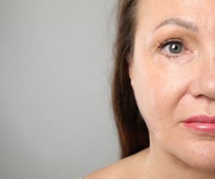 Photo of Woman before cosmetic procedure on grey background, closeup. Space for text