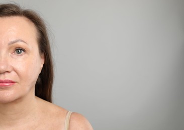 Photo of Woman before cosmetic procedure on grey background, closeup. Space for text