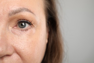 Photo of Woman before cosmetic procedure on grey background, closeup. Space for text