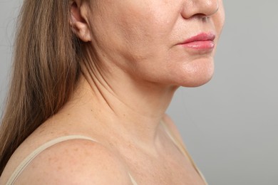 Photo of Woman before cosmetic procedure on grey background, closeup