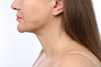 Photo of Woman before cosmetic procedure on white background, closeup
