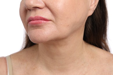 Photo of Woman before cosmetic procedure on white background, closeup