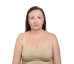 Photo of Woman before cosmetic procedure on white background