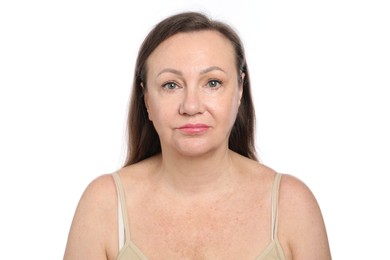 Photo of Woman before cosmetic procedure on white background