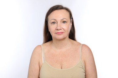 Photo of Woman before cosmetic procedure on white background