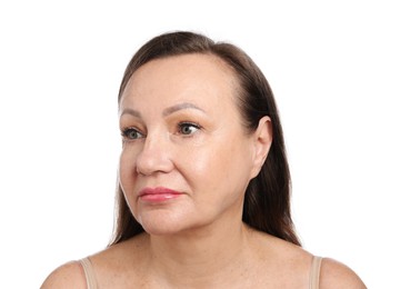 Photo of Woman before cosmetic procedure on white background