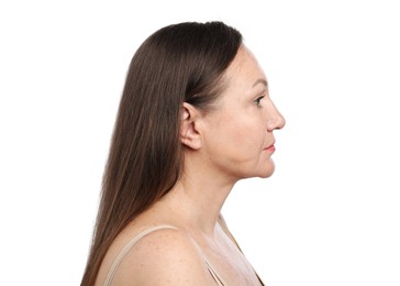 Photo of Woman before cosmetic procedure on white background