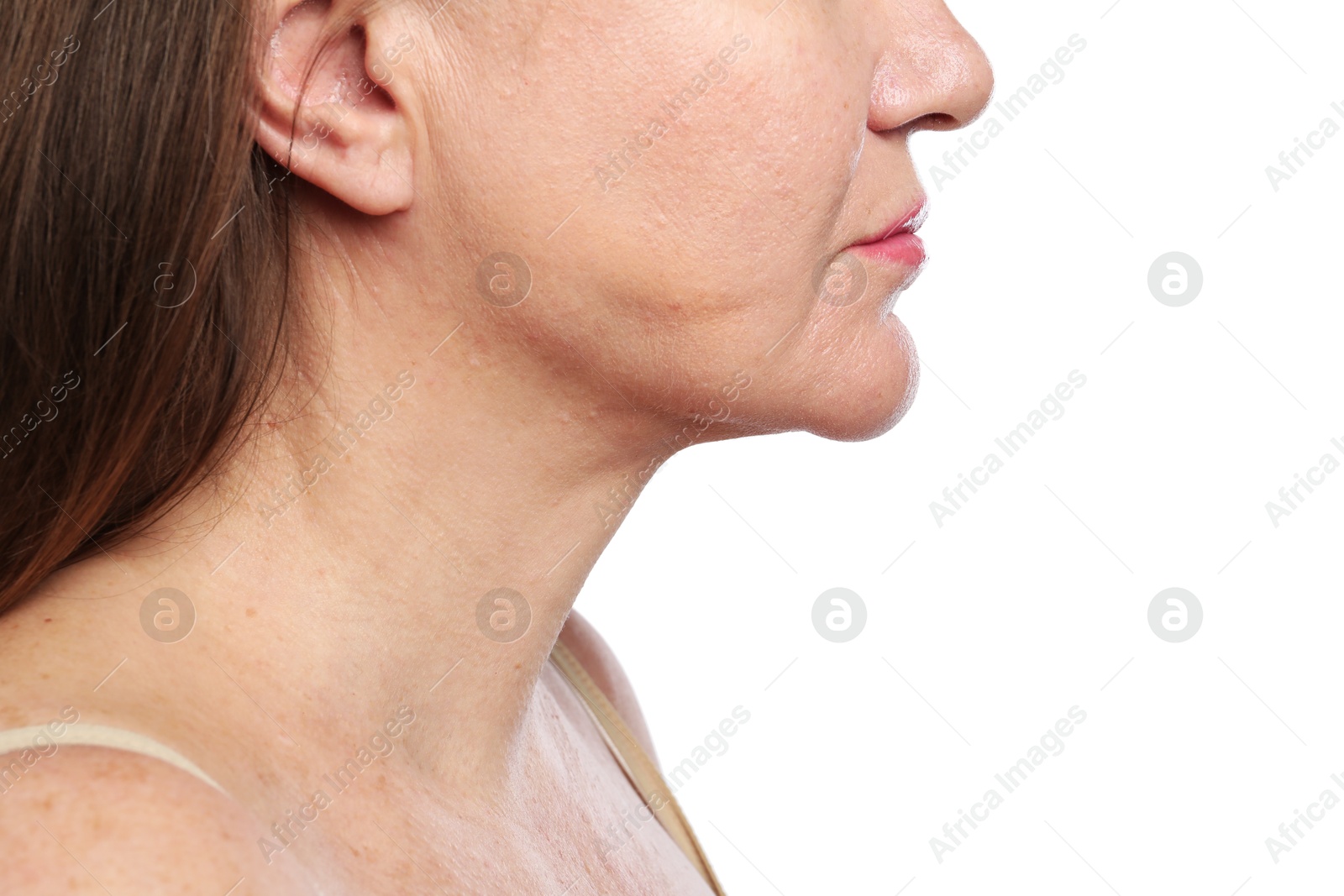 Woman before cosmetic procedure on white background, closeup Photo of Woman before cosmetic procedure on white background, closeup