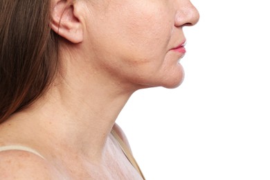 Photo of Woman before cosmetic procedure on white background, closeup
