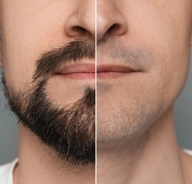 Image of Man before and after shaving on grey background, closeup. Collage of photos