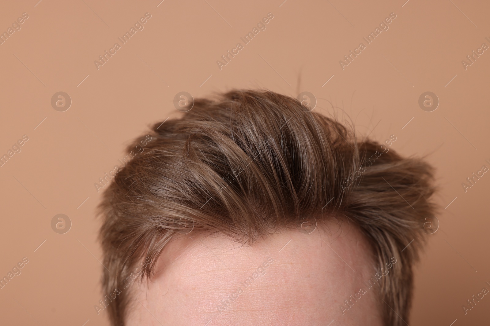 Man after hair loss treatment on beige background, closeup Photo of Man after hair loss treatment on beige background, closeup