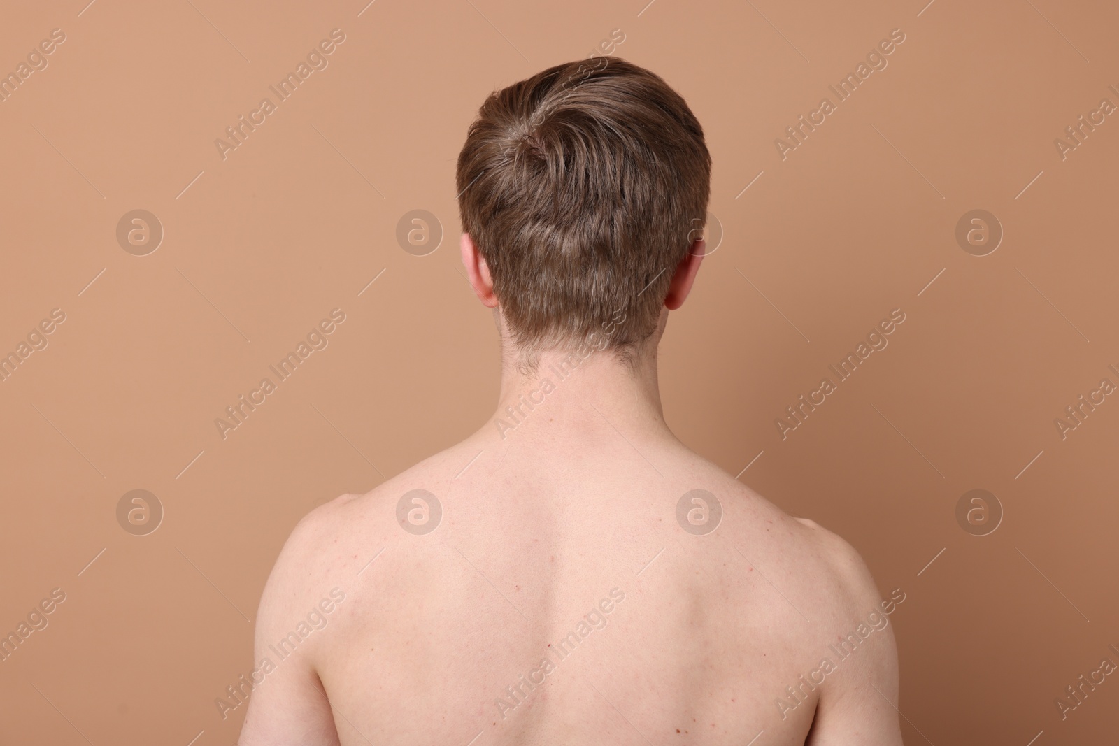 Man after scoliosis treatment on beige background, back view Photo of Man after scoliosis treatment on beige background, back view