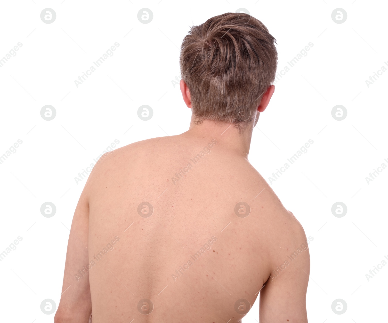 Man before scoliosis treatment on white background, back view Photo of Man before scoliosis treatment on white background, back view