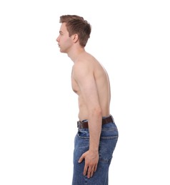 Photo of Man before scoliosis treatment on white background