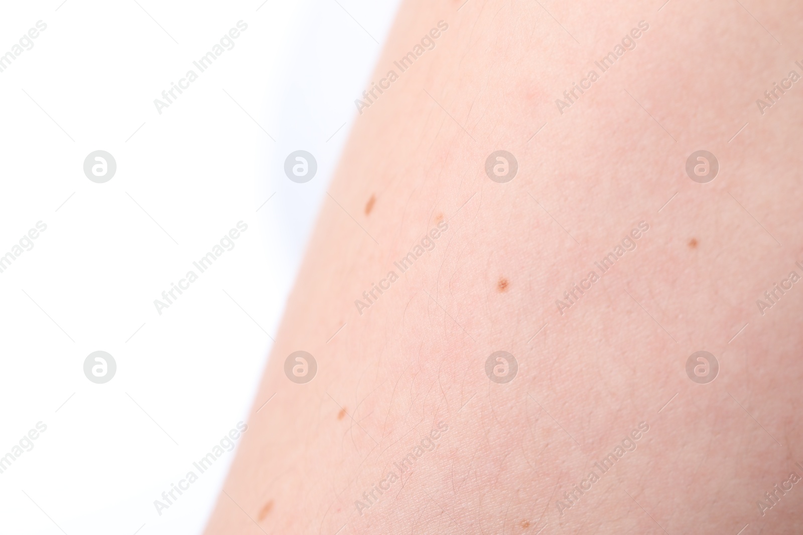 Woman with moles on her body against white background, closeup Photo of Woman with moles on her body against white background, closeup