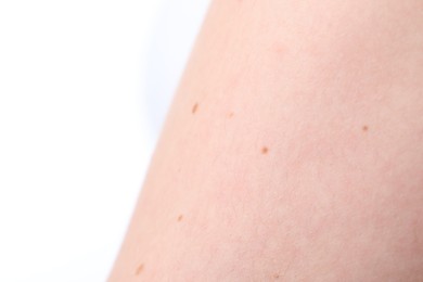 Photo of Woman with moles on her body against white background, closeup