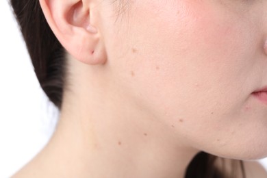 Photo of Woman with moles on her face against white background, closeup