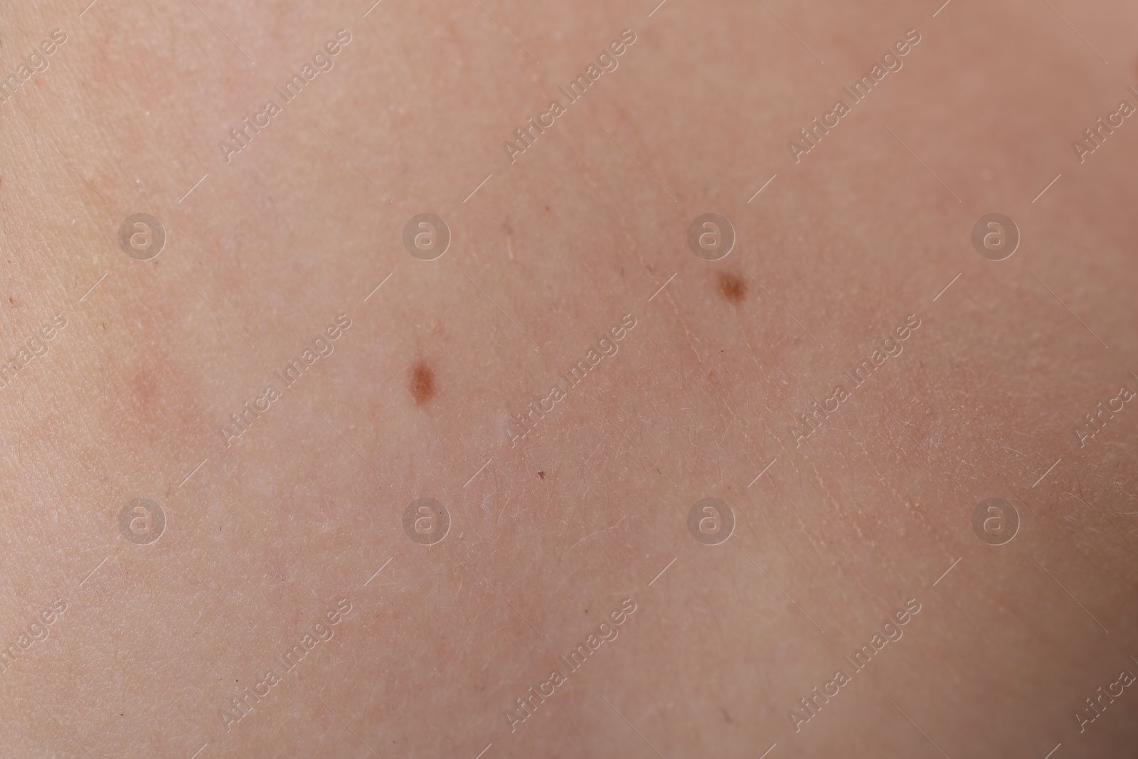 Woman with moles on her body, closeup Photo of Woman with moles on her body, closeup